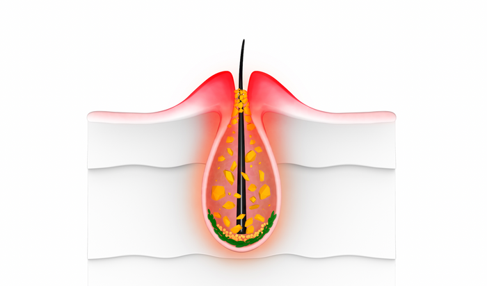 Can inflammation cause hair loss?